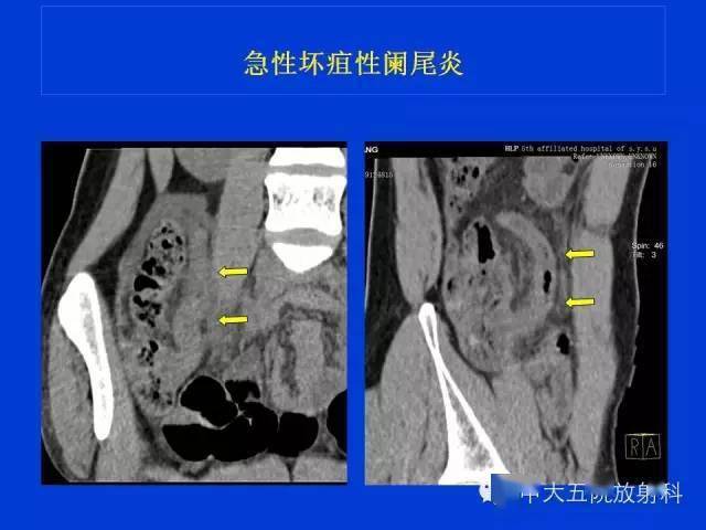 全面详解正常阑尾和阑尾炎的ct表现