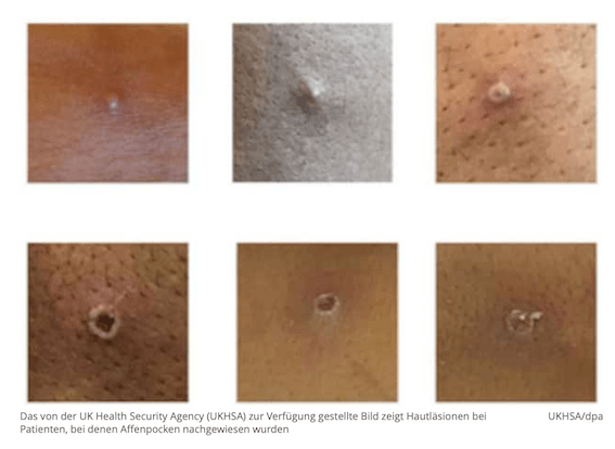 德国也发现首例猴痘感染,世卫组织呼吁追踪隔离接触人_病例_传播_病毒
