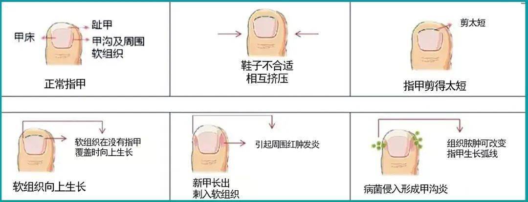 甲沟炎发作常见原因夏季天气炎热,出汗增多,各类病菌真菌活跃,且足部