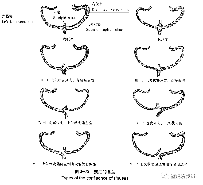 1) 简单型 22% 2)双分支型 26% 3)上矢状窦偏侧型 32% (上矢状窦偏右