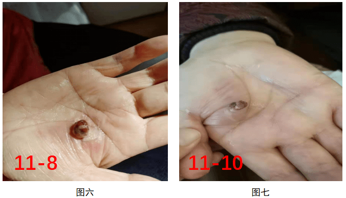 卡瑞利珠单抗导致反应性皮肤毛细血管增生症这样处理效果不错