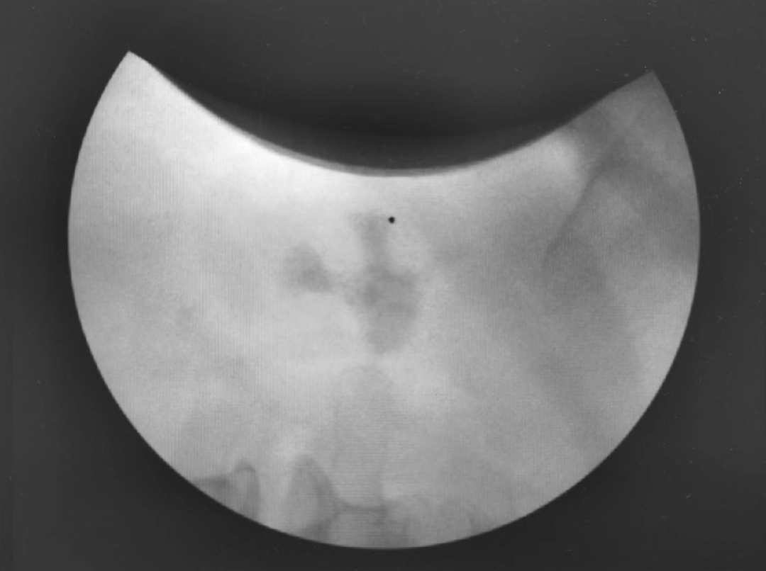 5cm 肾结石,eswl 20分钟完全碎石_资料_石史_患者