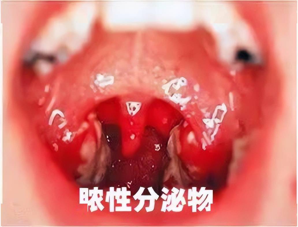 咽及扁桃体明显充血,能看到脓性分泌物孩子会有咽痛,吞咽痛