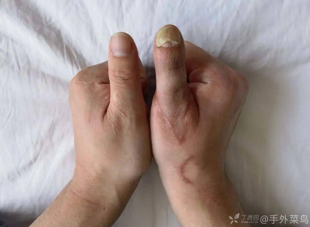 我把患者的脚趾移植到了手指上