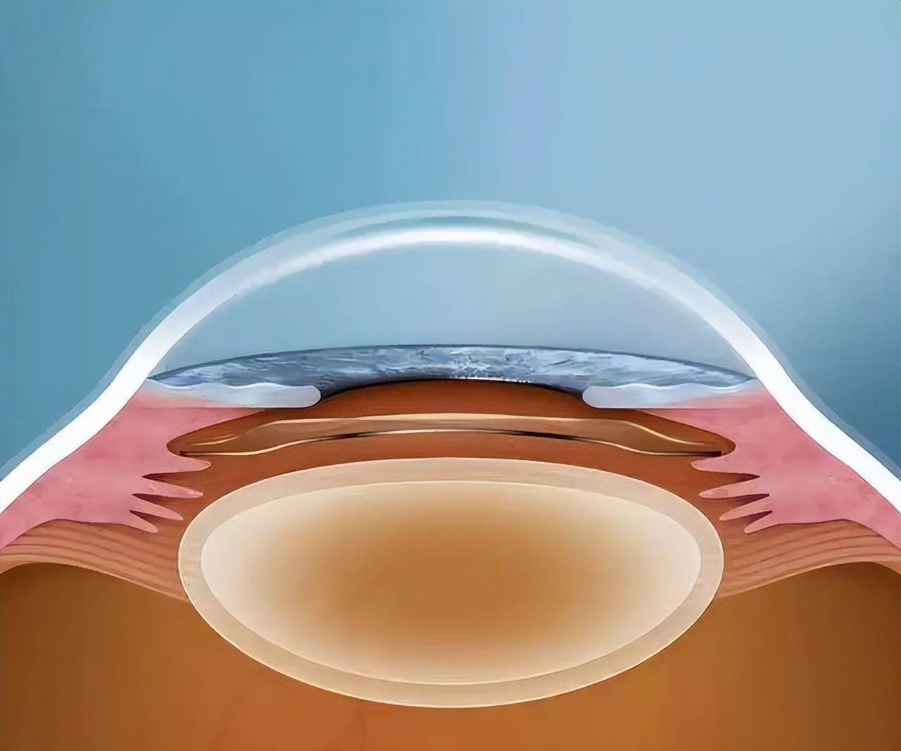 icl晶体植入术:高度近视也可以"摘镜"_手术_屈光_角膜