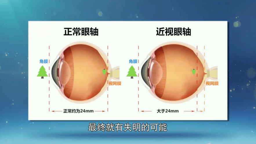 眼科专家透露“治疗近视”真相：近视手术不能治愈近视！插图2