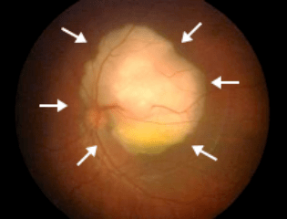 孩子眼睛里长了个白点没想到竟然是癌