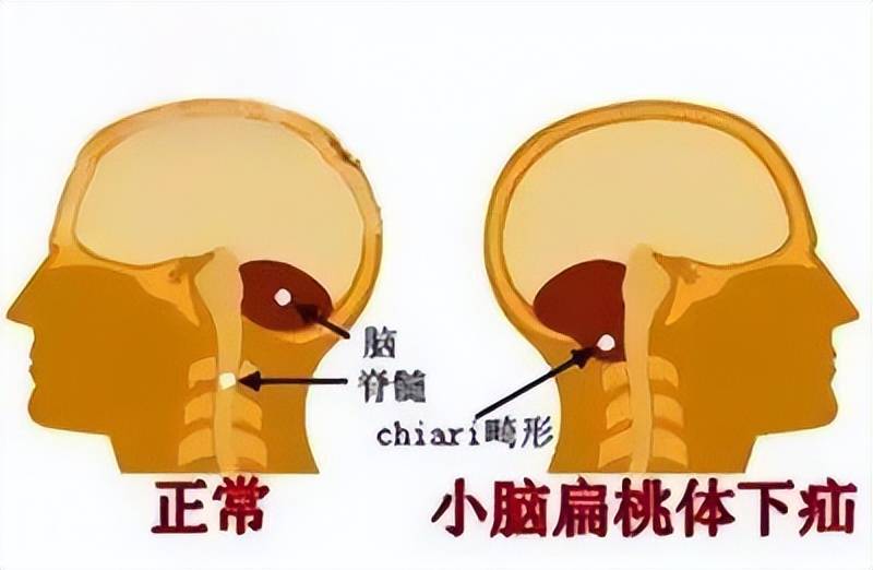 小脑扁桃体解剖图图片