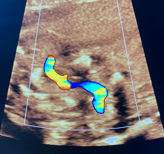 迷走右锁骨下动脉的胎儿超声心动图诊断