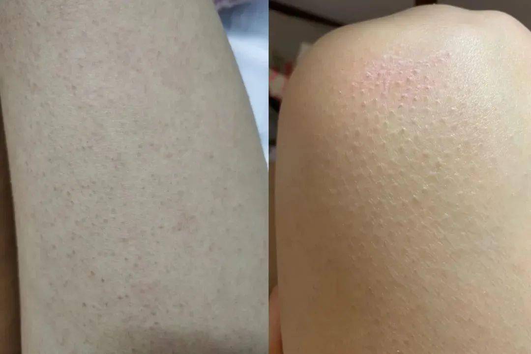 天热皮肤起鸡皮(天气冷皮肤起鸡皮)