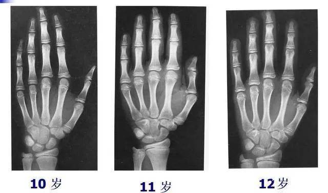 骨龄是青少年儿童骨骼发育水平同骨发育标准比较而得出的发育年龄