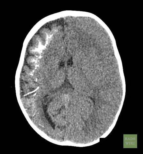 2岁小孩一侧脑萎缩你怎么看