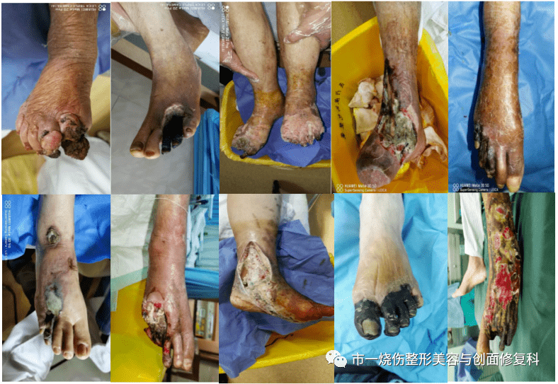 会烂脚的糖尿病足,该怎么预防与治疗?