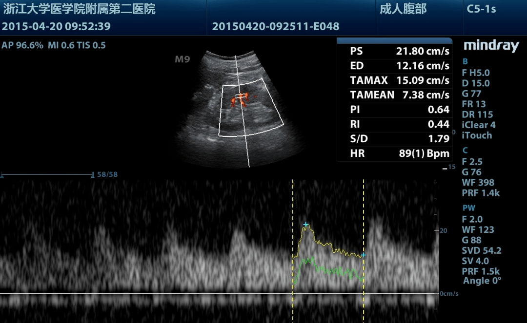 零基礎入門「床旁腎臟超聲」,掌握切面與測量就夠了!