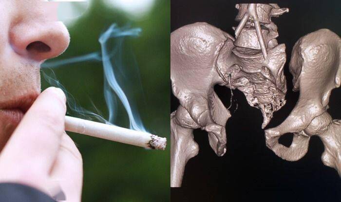 吸烟的男人更容易骨折和早死