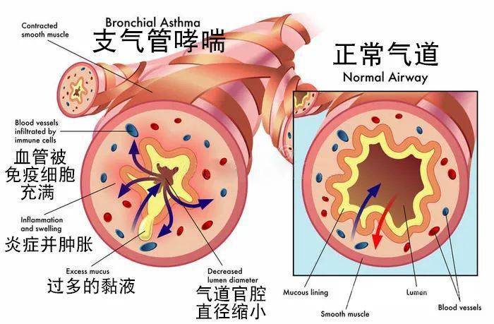 哮喘发病机制示意图图片