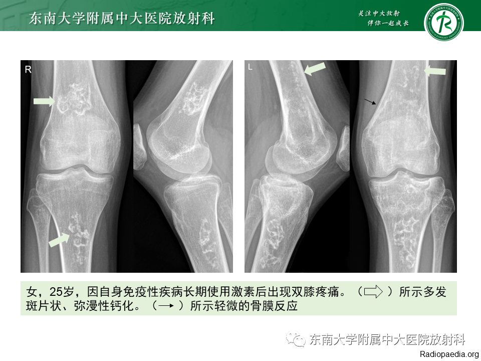 骨梗死影像表现