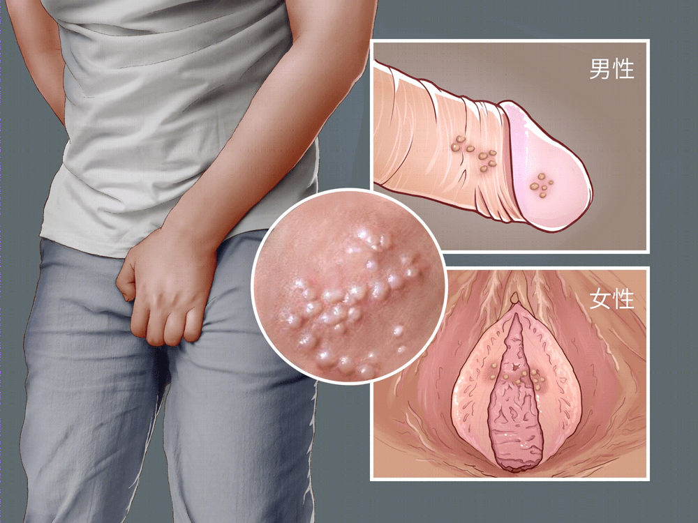 生殖器疱疹,听说在潜伏期也会传染._症状_男性_龟头