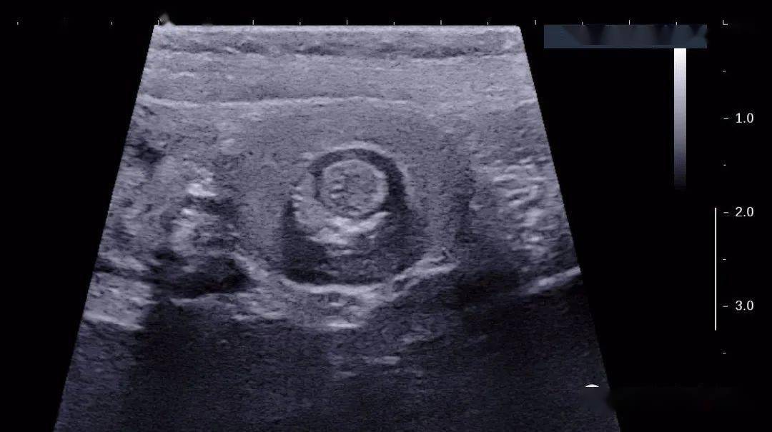 小儿肠套叠的超声图谱图片