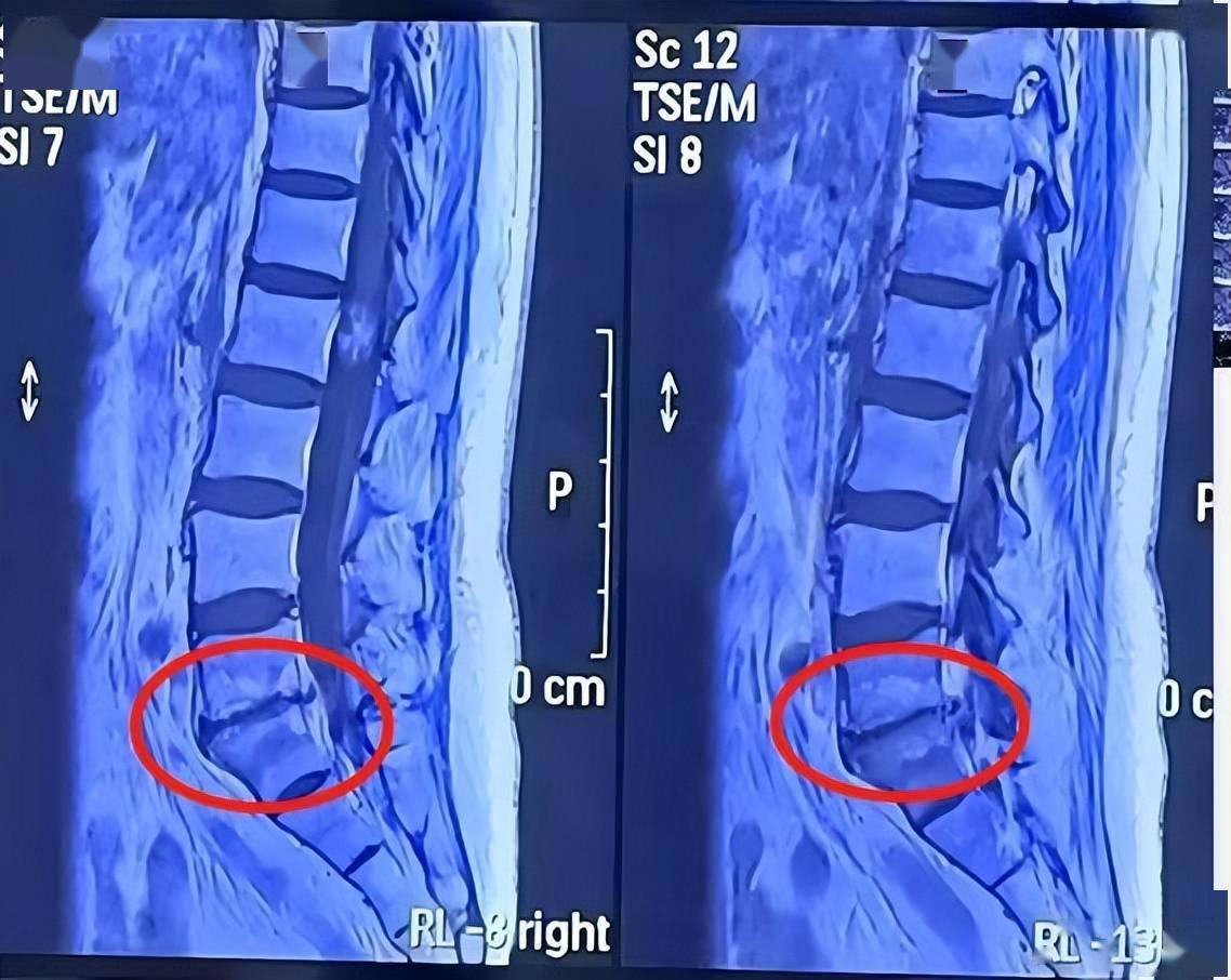 腰椎磁共振片子图片