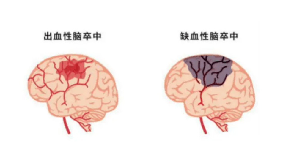 出血性脑卒中(脑出血,脑溢血):脑部血管破裂出血,挤压其他血管和脑