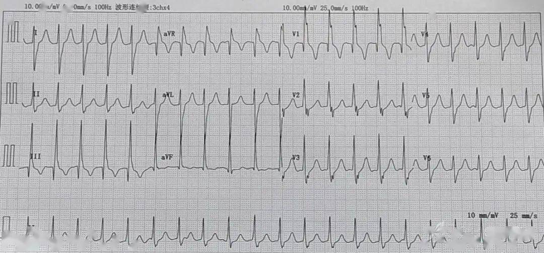 室速的心电图表现图片