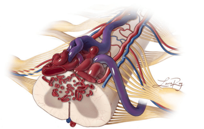 【节目预告】 肢体麻木,小心脊椎脊髓病_疾病_动静脉_治疗