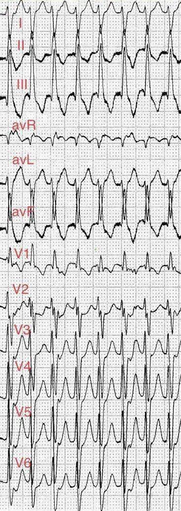 8份真假分支型室速心电图你能正确识别吗