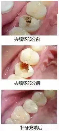 淺齲中齲補牙就可以了深齲牙髓炎要怎麼辦