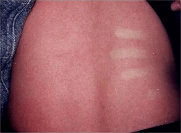 小小疹子,不可忽视,皮肤问题可大可小_kaposi_儿童_病毒