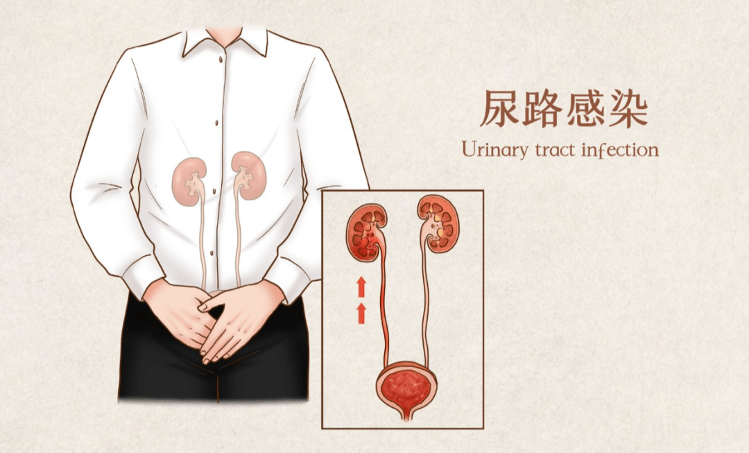 女性尿路感染是指发生在女性,由病原微生物在肾脏,输尿管,膀胱和尿道