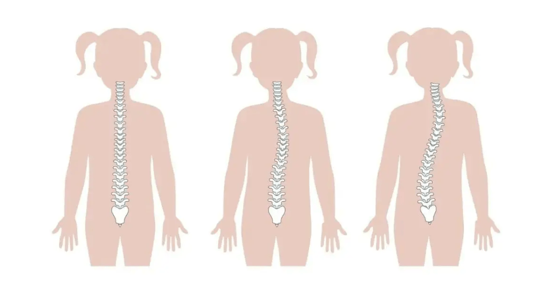 脊柱侧弯及不良体态对儿童青少年的身心健康有严重影响,除了影响形体