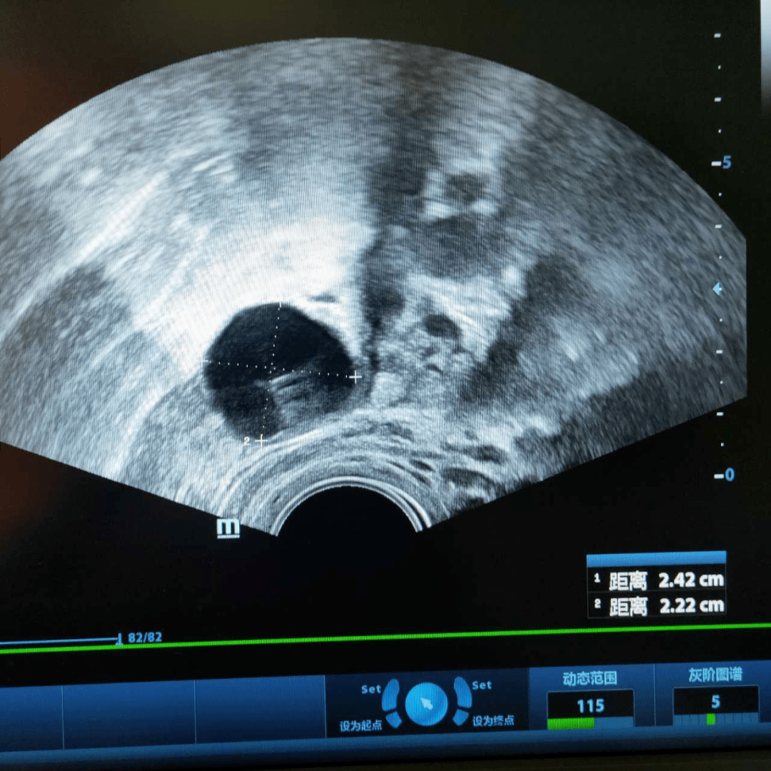 ③ b超检测排卵.该方法最准确最有效,是医生推荐的测排卵首选.