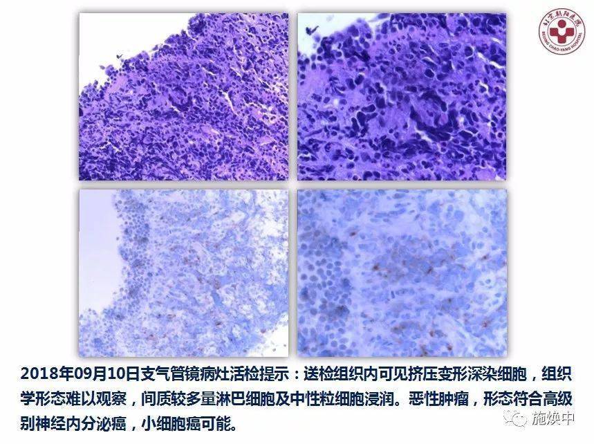 施焕中教授:产后 4 周诊断晚期肺癌,引出诸多思考_检查_胸腔_细胞