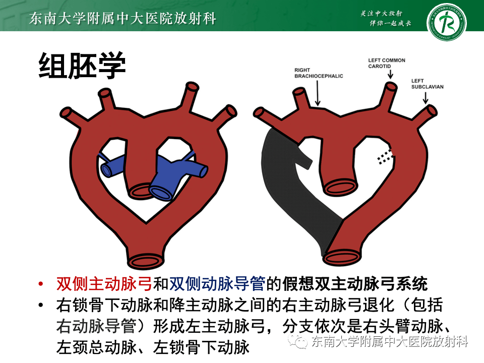 主動脈弓離斷