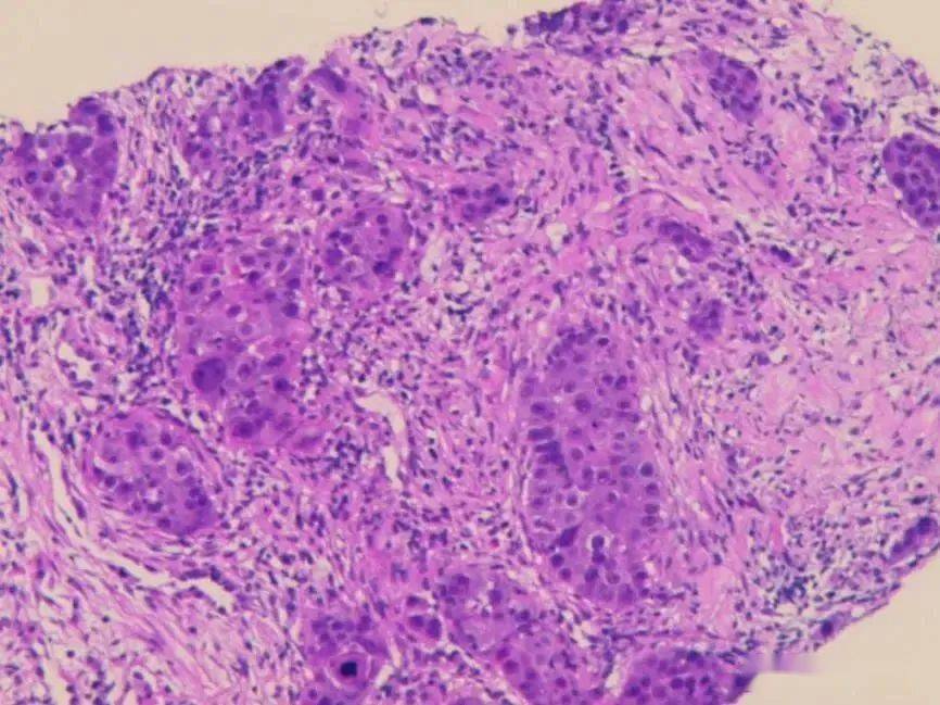 鳞癌病理图片图片