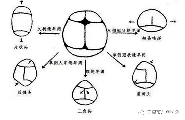 宝宝头型异常不一定是睡偏了警惕儿童颅缝早闭症