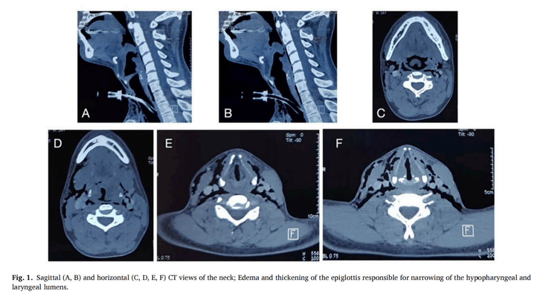 14小時後頸部ct掃描顯示會厭水腫增厚,導致下嚥腔和喉腔狹窄(圖1:a,b