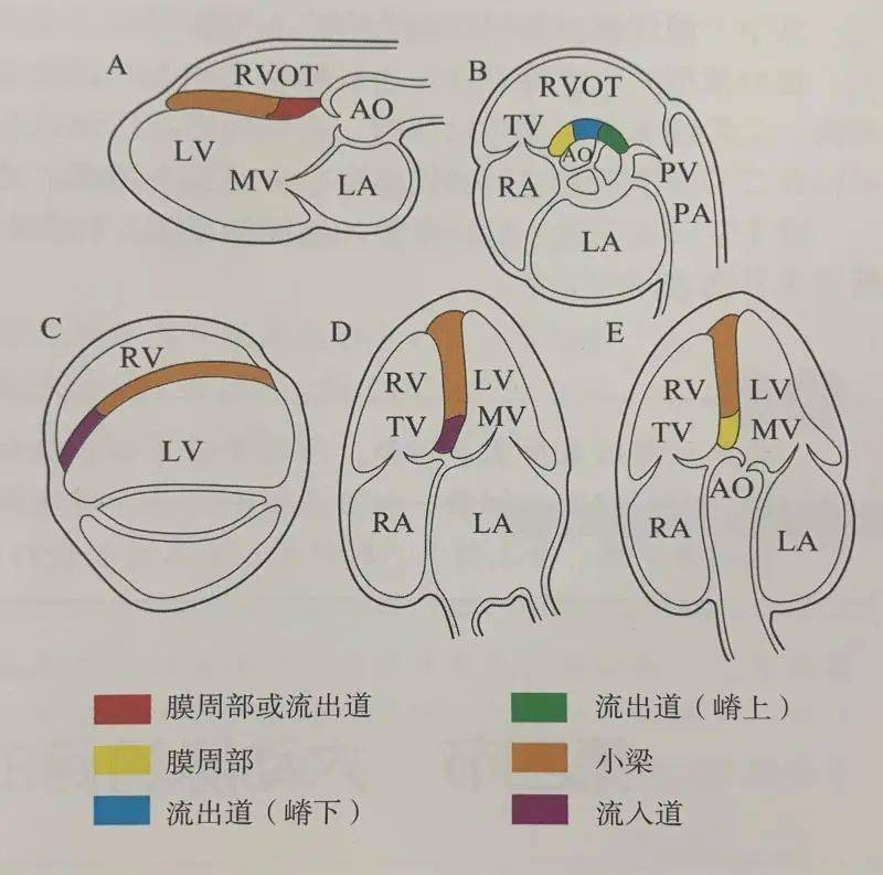 图 2 超声心动图切面及 vsd 分型图片来源:参考文献图 3 左室长轴切面