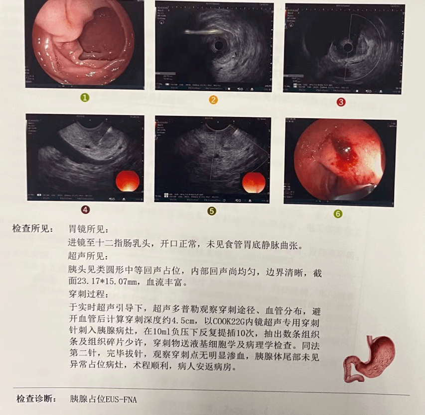 病例分享丨一例胰岛素瘤患者的麻醉处理