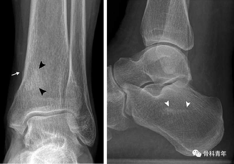 辨析 应力性骨折 非典型骨折与病理性骨折的影像鉴别 诊断 皮质 标准