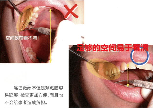 牙周探针使用方法图片