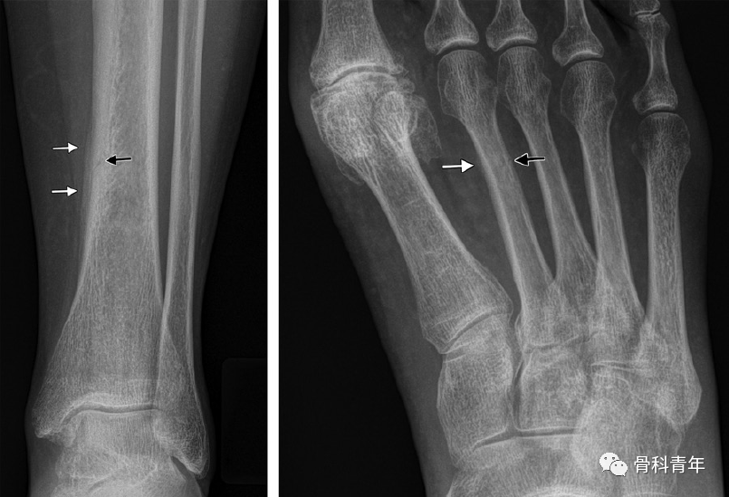 骨小梁断裂图片图片