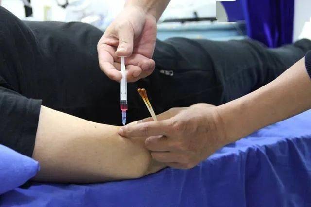 针灸水针和火针