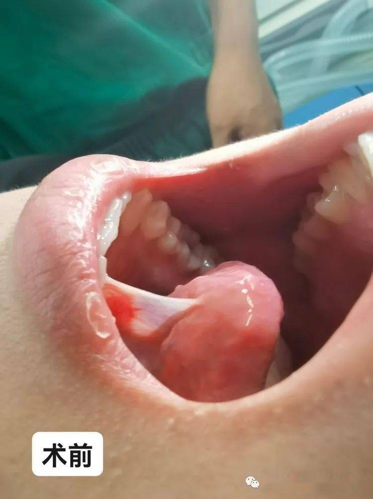 成人舌系带手术图片
