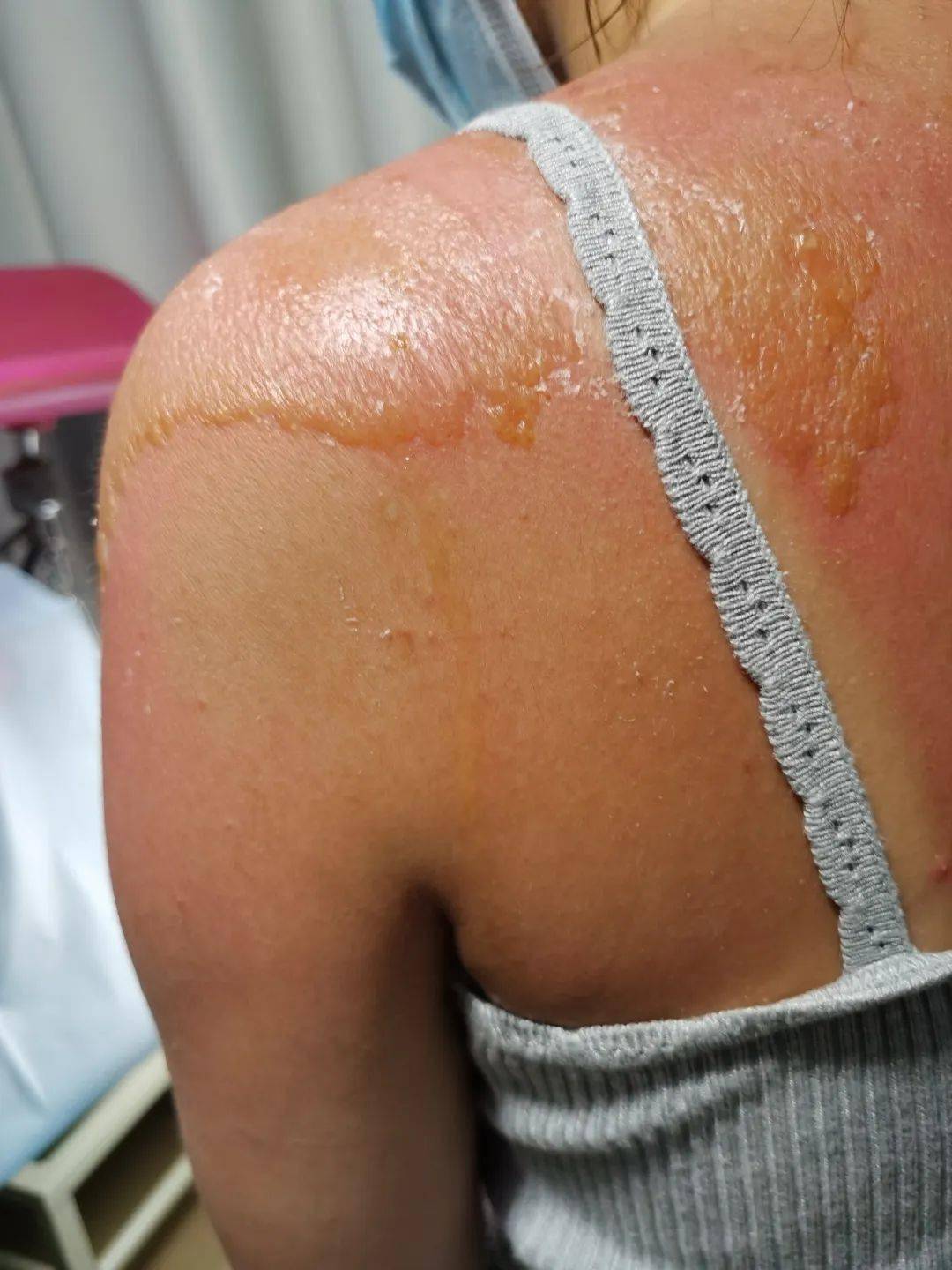 女子三亚旅游回杭,心情却跌入谷底_皮肤_日光_紫外线