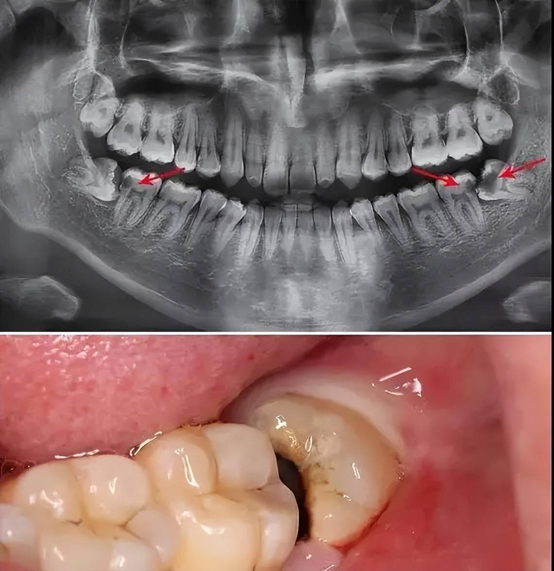 看牙避坑指南:拔智齒前糾結的那些事兒,一次性和你嘮清楚_醫生_牙齦