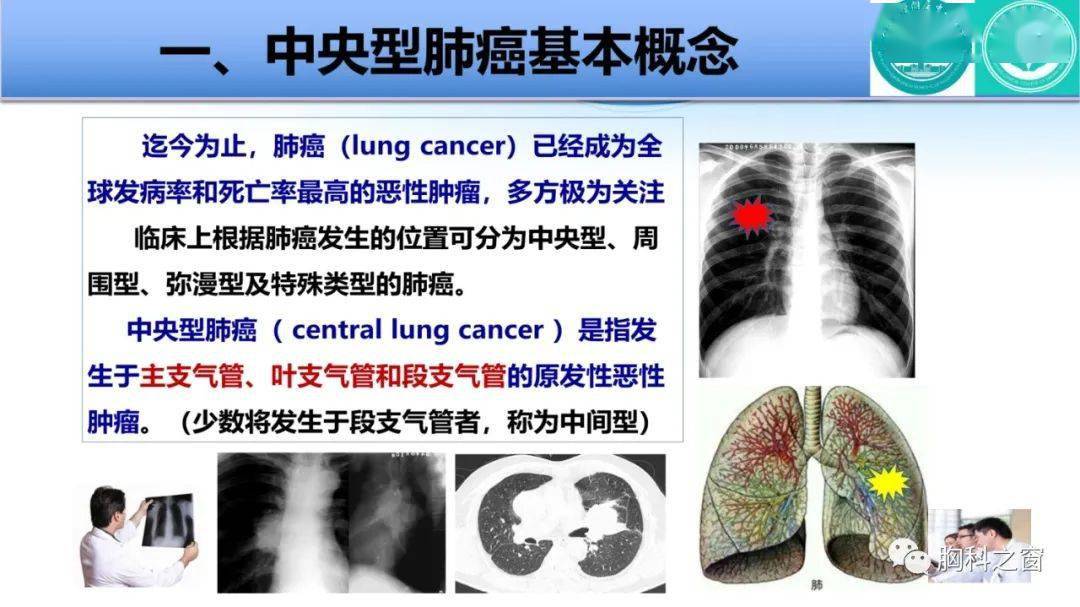 中央型肺癌图片