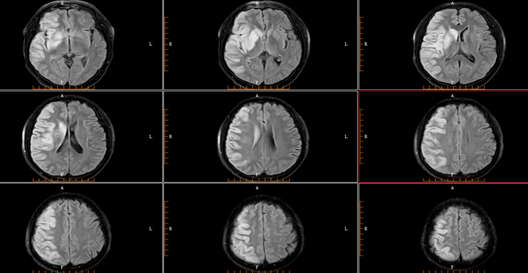 右側額葉,頂葉,顳葉,島葉,及基底節區多發斑片狀高信號(dwi序列),考慮
