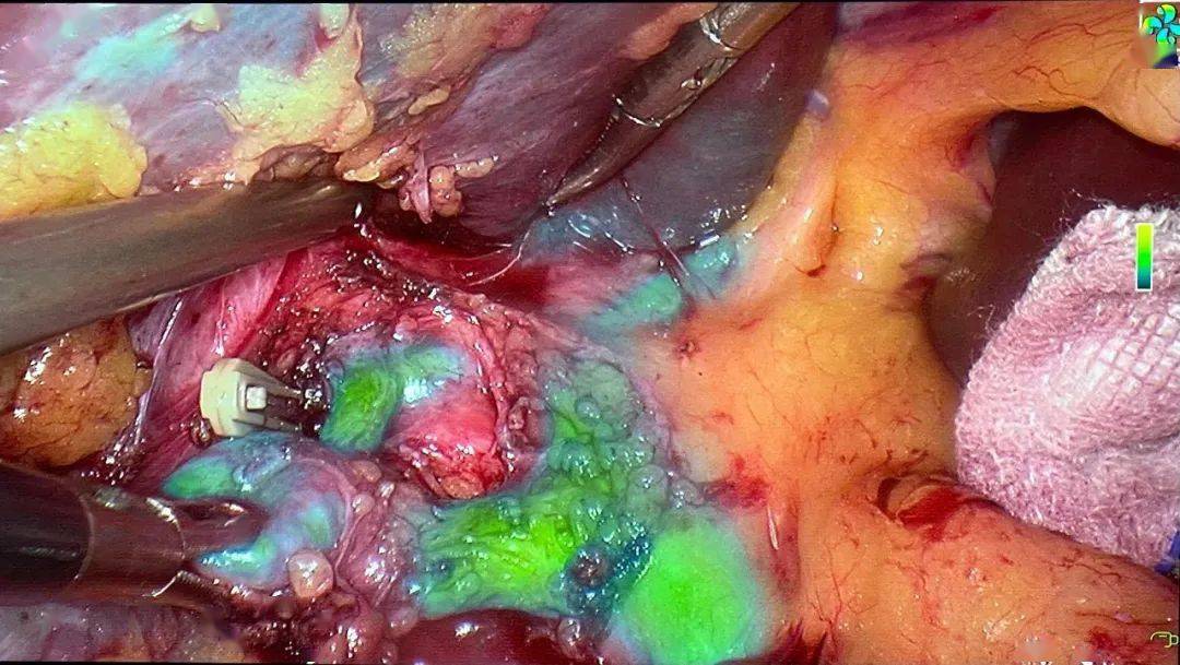 【醫療技術】熒光顯影導航技術讓外科手術更精準_患者_膽囊_膽管